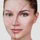acne-espinhas