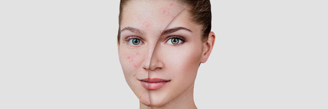 acne-espinhas