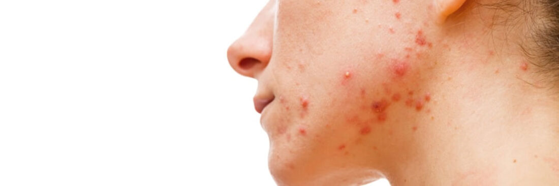 graus-e-tipos-de-acne-espinhas