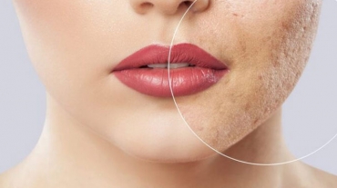 qual-o-melhor-tratamento-para-acne-na-adolescencia