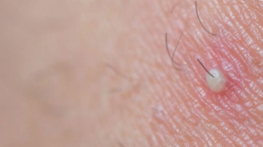 cortou-seu-cabelo-recentemente-e-sentiu-bolinhas-entenda-a-foliculite